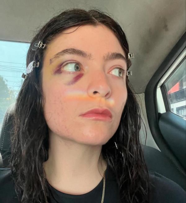 Lorde shares cryptic post with several photos of her black eye on September 30, 2024.